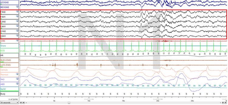 Non-rapid eye movement sleep