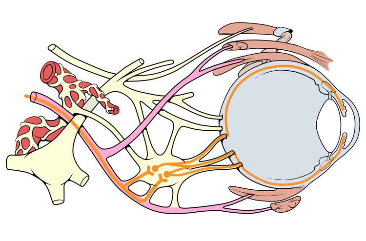 Oculomotor nerve palsy