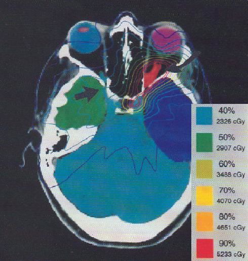 Optic nerve sheath meningioma