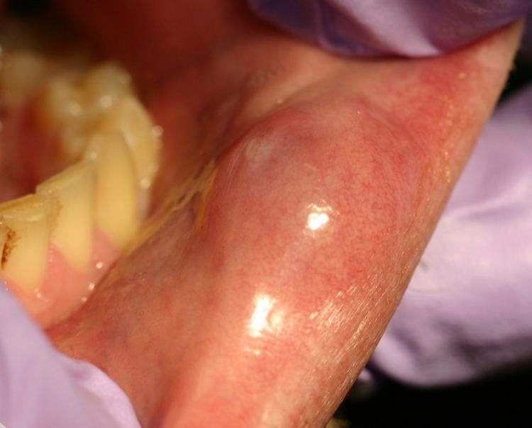Oral mucocele