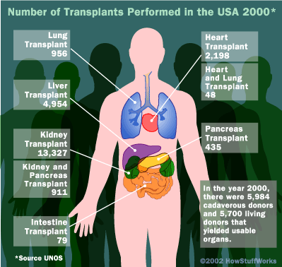 Organ transplantation How Organ Transplants Work HowStuffWorks