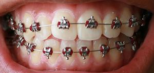 Orthodontic archwires