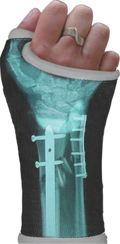 Orthopedic cast Orthopedic Casts Custom Designed With Your Own XRay