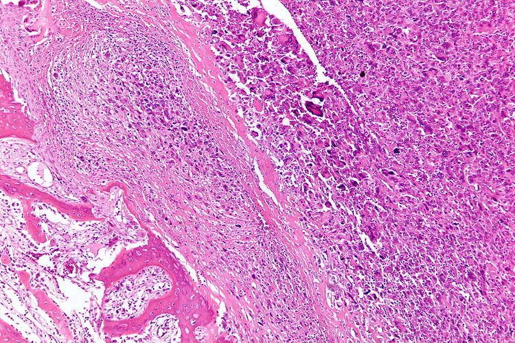 Osteosarcoma