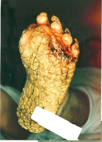 Palmoplantar keratoderma