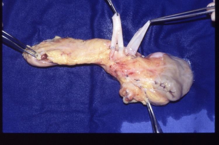 Pancreas transplantation