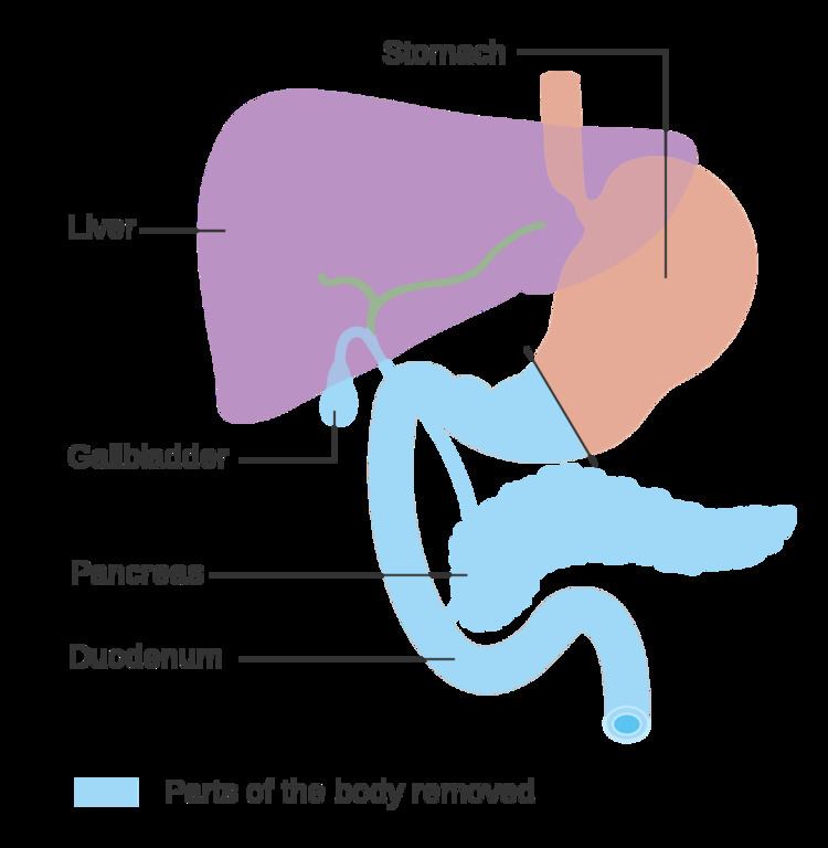 Pancreatectomy