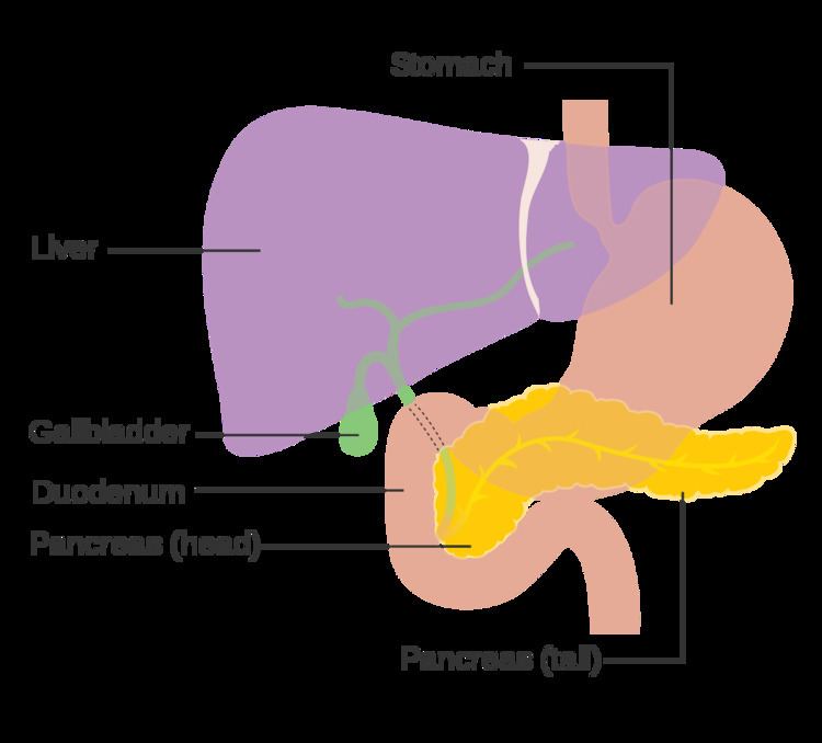 Pancreatic neuroendocrine tumor