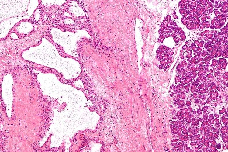 Pancreatic serous cystadenoma
