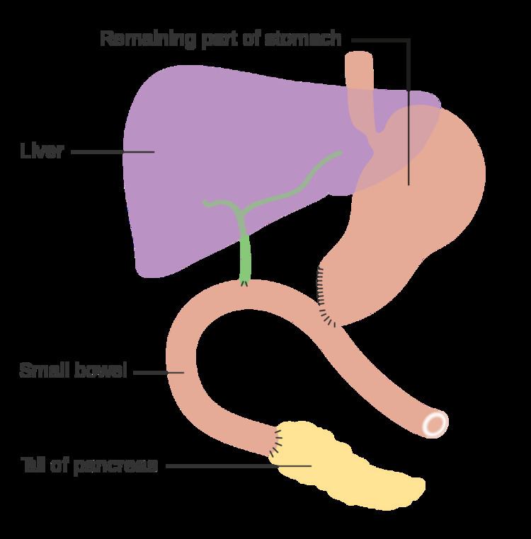 Pancreaticoduodenectomy