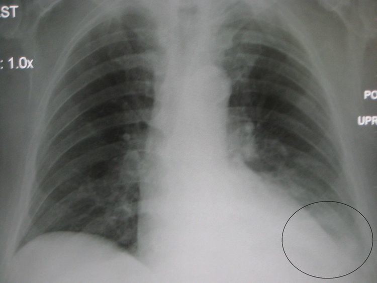 Parapneumonic effusion