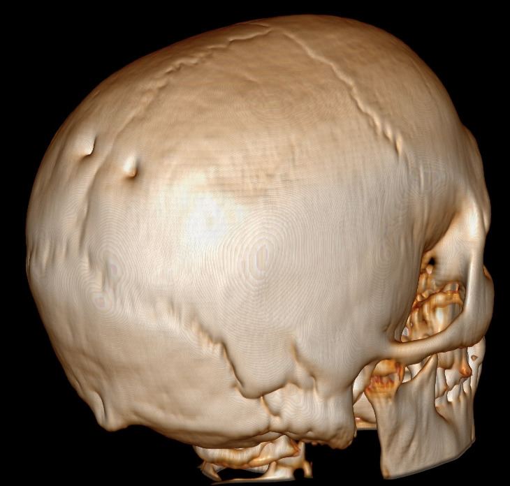 Parietal foramen