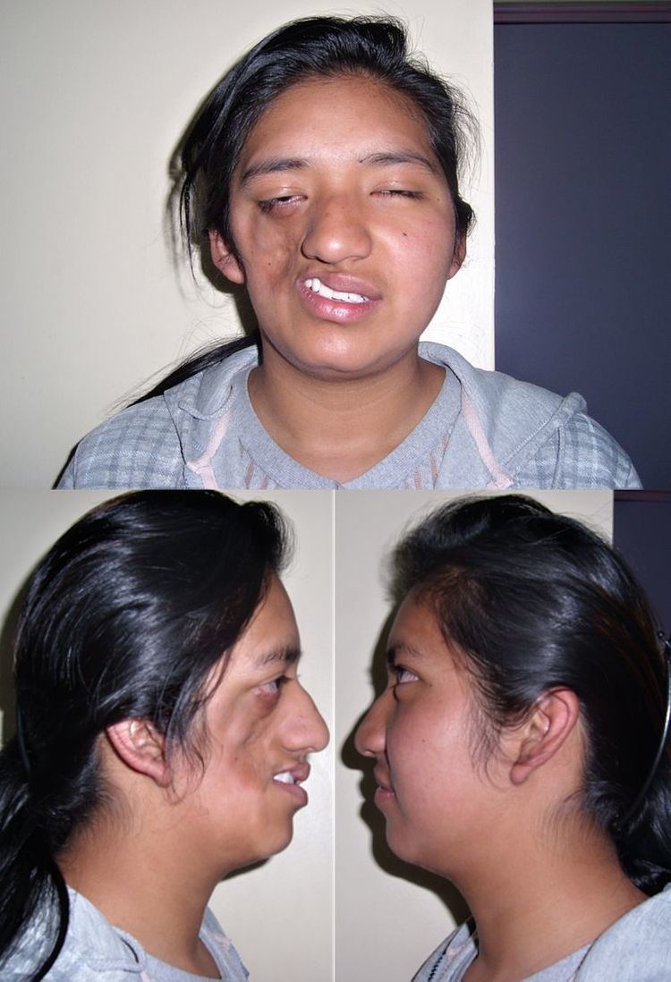 Parry–Romberg syndrome
