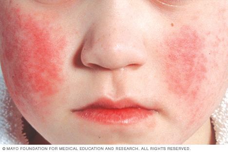 Parvovirus Parvovirus infection face rash Mayo Clinic