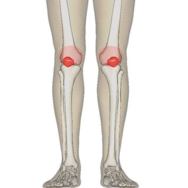 Patellofemoral pain syndrome