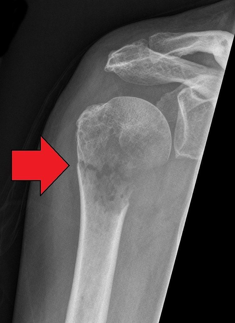 osteoporosis-without-current-pathological-fracture-cruisefilo