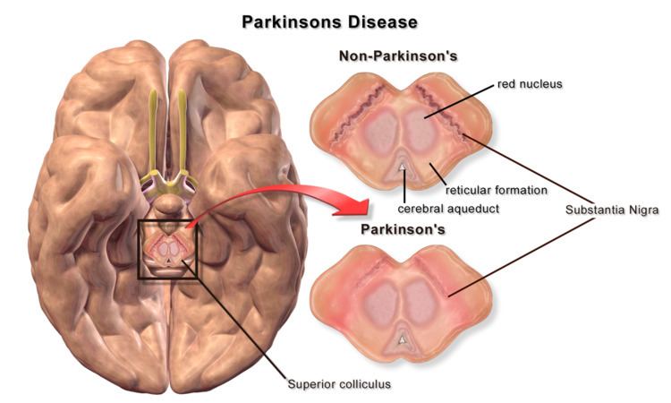 Pathophysiology of Parkinson's disease
