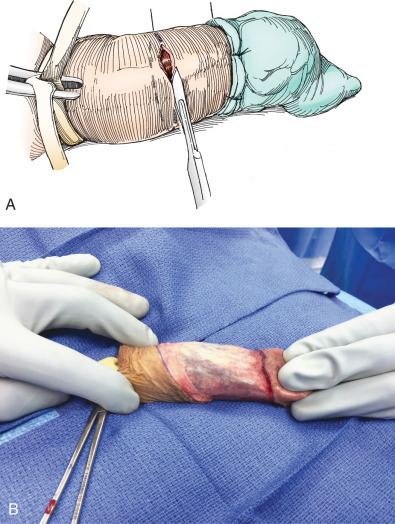 An illustration of Penectomy operation (upper), and The actual operation Penectomy (lower)