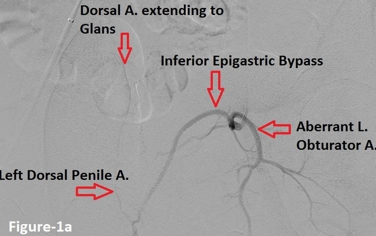 Penile Artery Shunt Syndrome