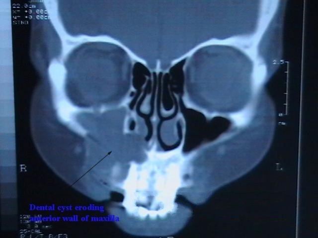 Periapical cyst - Alchetron, The Free Social Encyclopedia