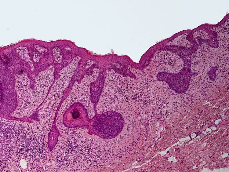 Perifollicular fibroma
