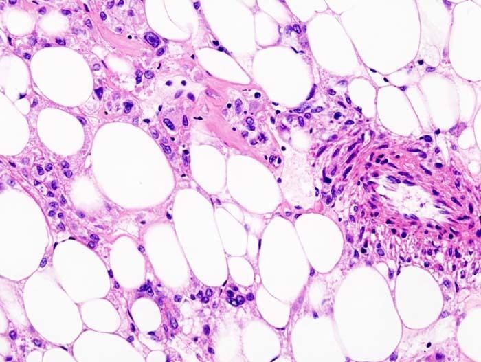 Perivascular epithelioid cell tumour