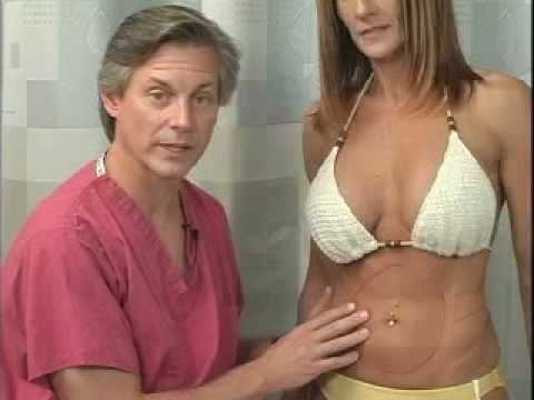 Peter McKenna Dr Peter McKenna Liposuction YouTube