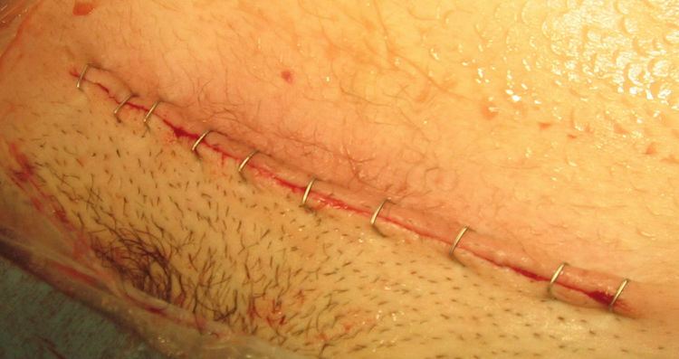 Pfannenstiel incision