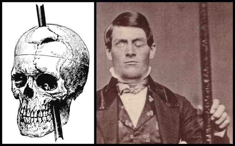 Phineas Gage Psychology or Neuroscience The case of forensics Mindwise