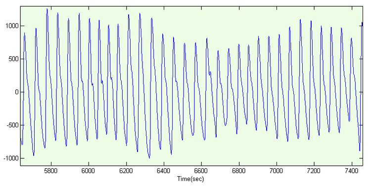 Photoplethysmogram