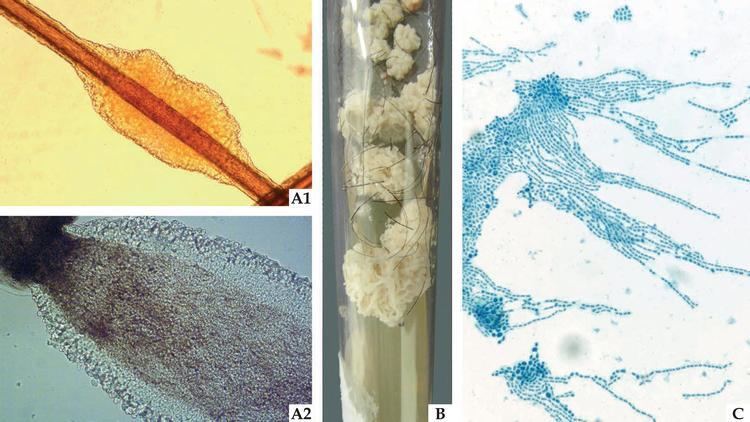 Mycological examinations of white piedra: (A1) Optical microscopy (x40) offering a detailed illustration of the light color nodule attached to the pillar shaft. (A2) Optical microscopy (x100) illustrates the yeasts the make up the structure on the edge of the nodule. (B) Culture Mycosel medium (Difco, USA) with yeast-like colony, with the cerebriform filamentous appearance. (C) Microgrowth demonstrates yeasts with blasto-arthrospores, typical of Trichosporon sp