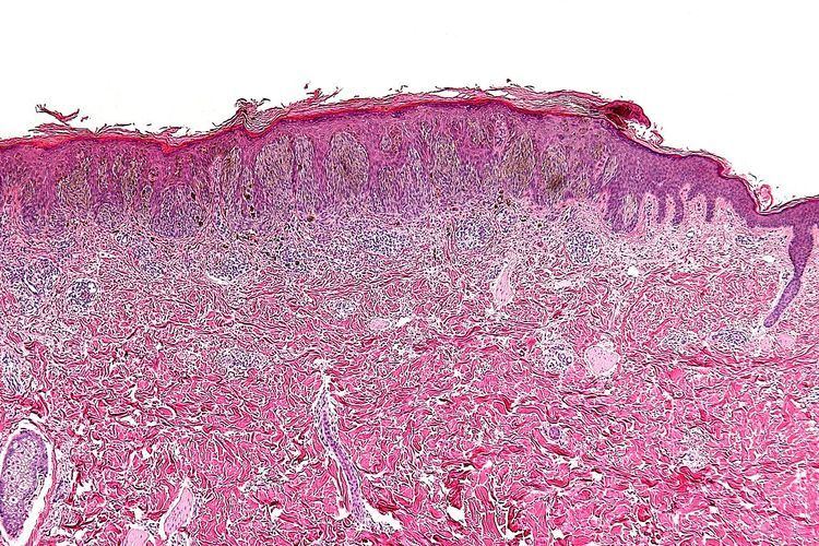 Pigmented spindle cell nevus