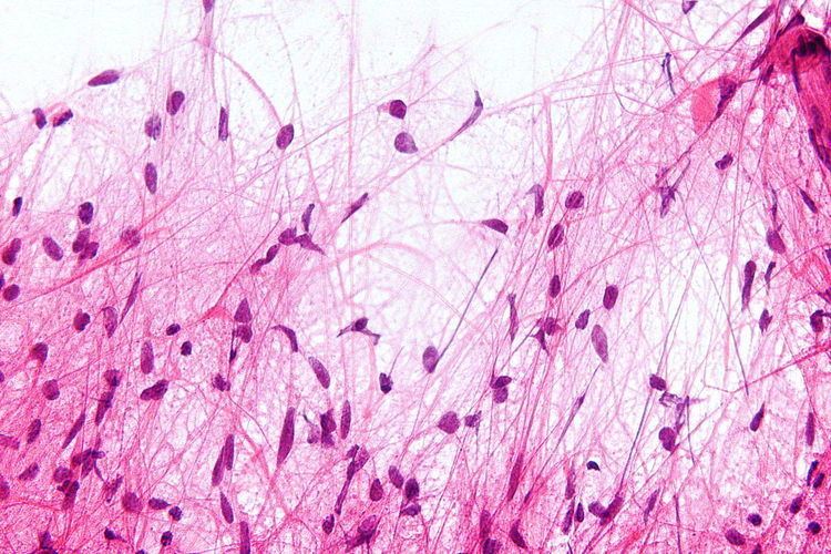 Pilocytic astrocytoma