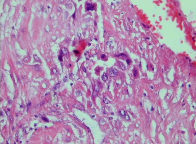 Placental site trophoblastic tumor