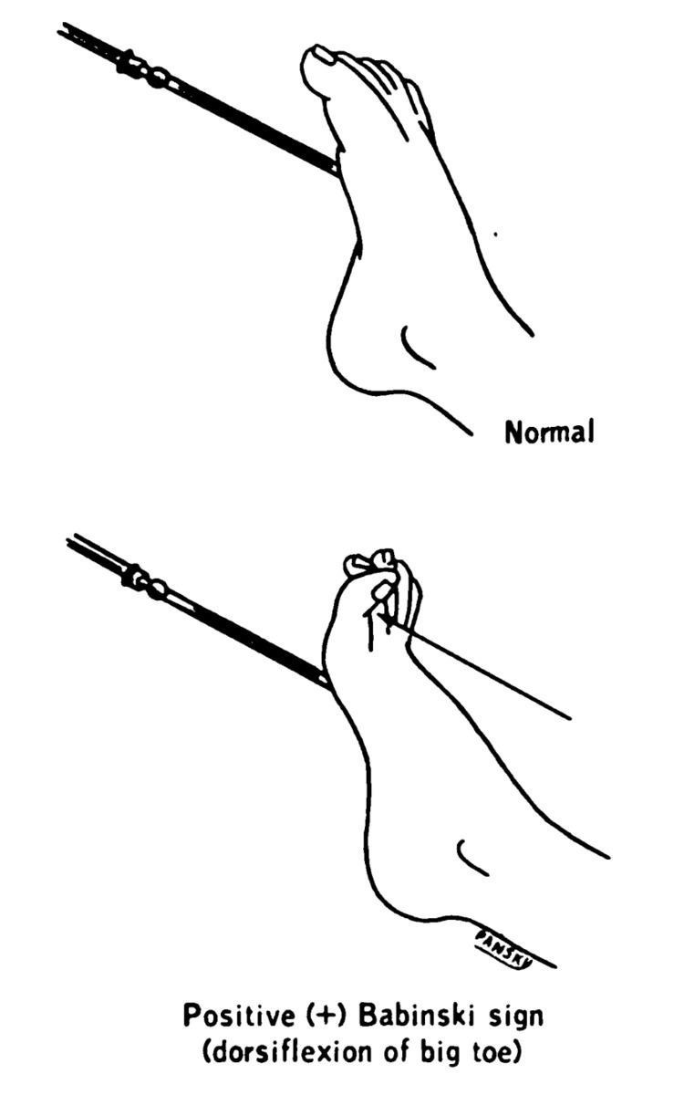 Plantar reflex