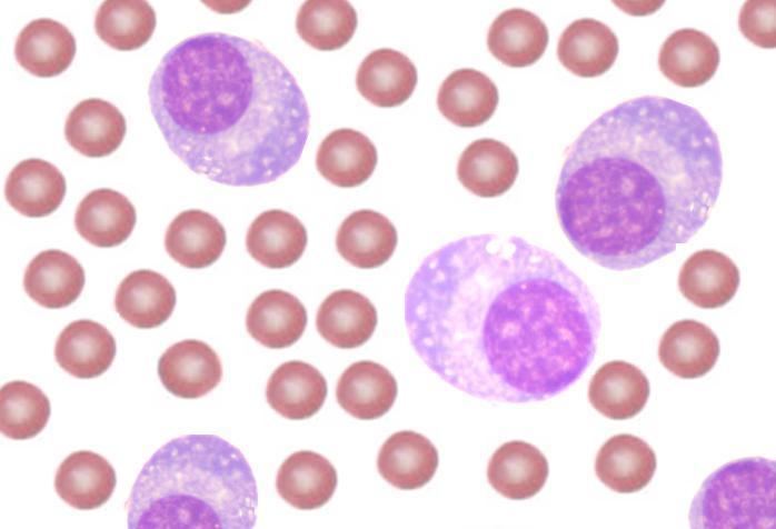 Plasma cell leukemia