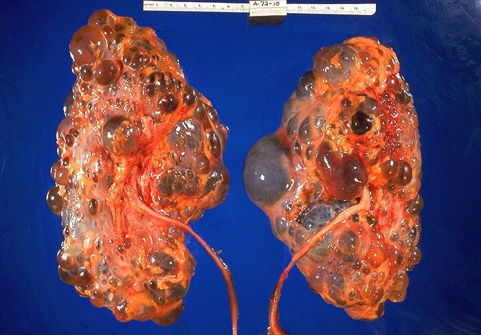 Polycystic kidney disease 3 (autosomal dominant)