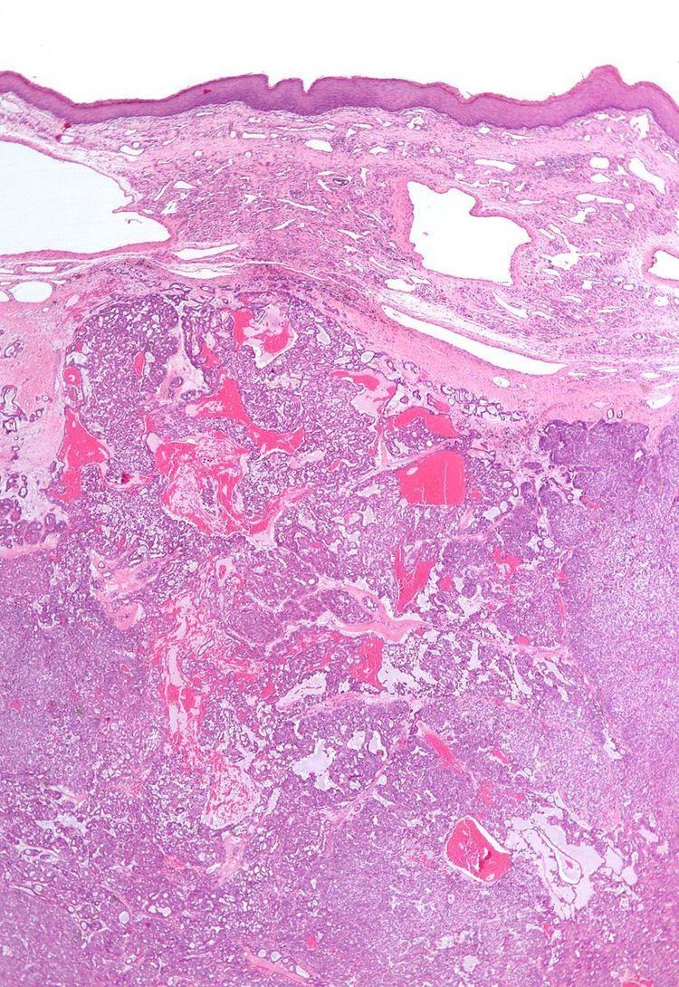 Polymorphous low-grade adenocarcinoma