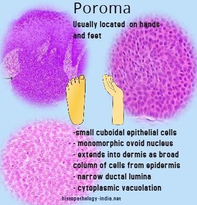 Poroma Pathology of Poroma Dr Sampurna Roy MD