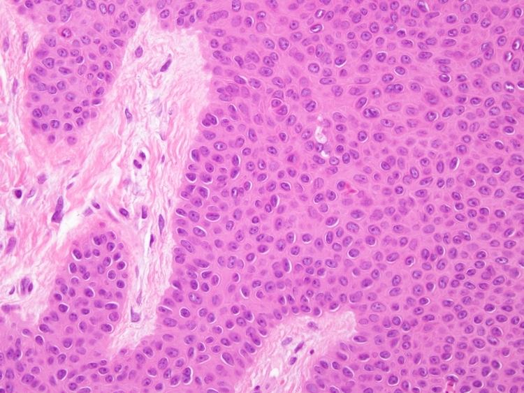 Poroma Eccrine poroma cells Dermatology Pinterest