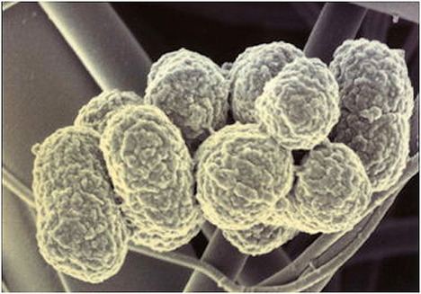 Porphyromonas gingivalis Gum Disease Bacteria May Be Risk Factor for Esophageal Cancer www