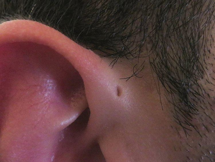 Preauricular sinus and cyst