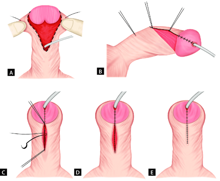 A to E: Sketch diagram of steps of preputioplasty. (A) Midpenile... |  Download Scientific Diagram
