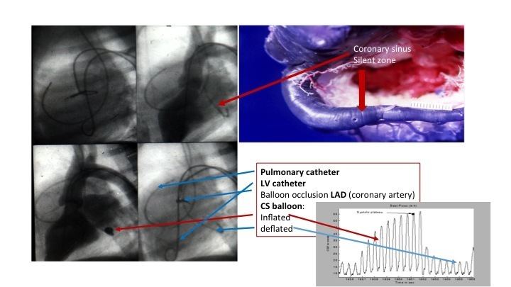 Pressure-controlled intermittent coronary sinus occlusion (PICSO)