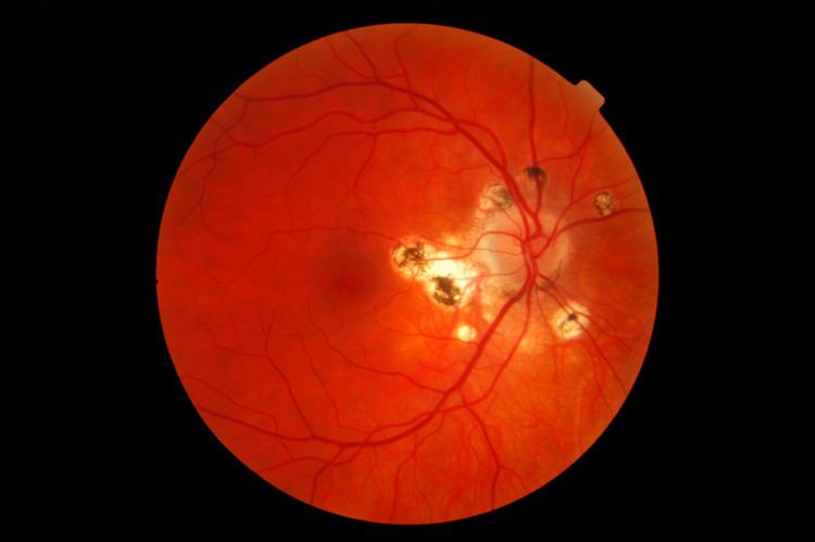 Presumed ocular histoplasmosis syndrome