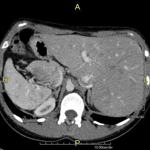 Primary ciliary dyskinesia