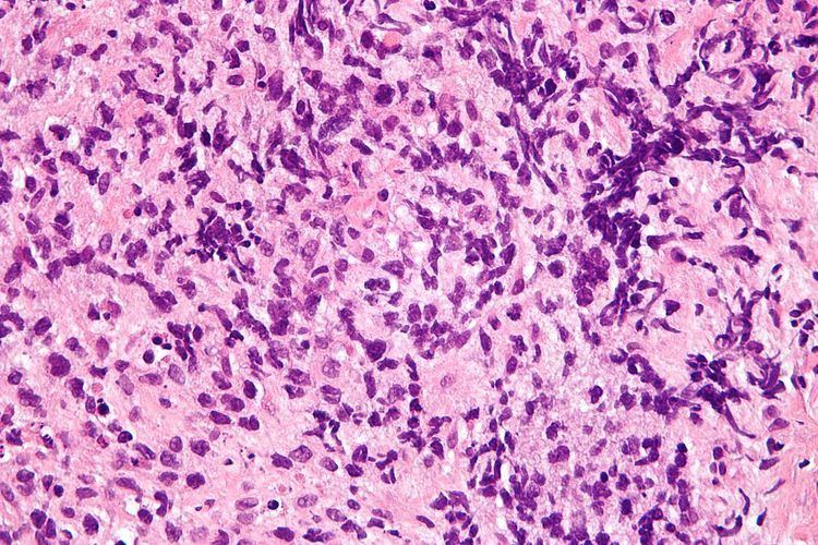 Primary mediastinal B-cell lymphoma