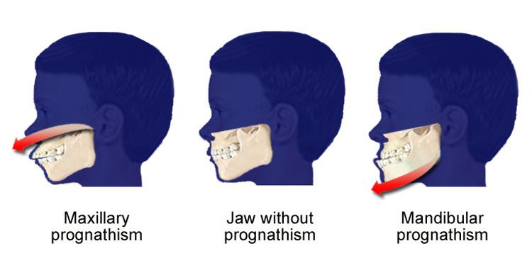 Prognathism