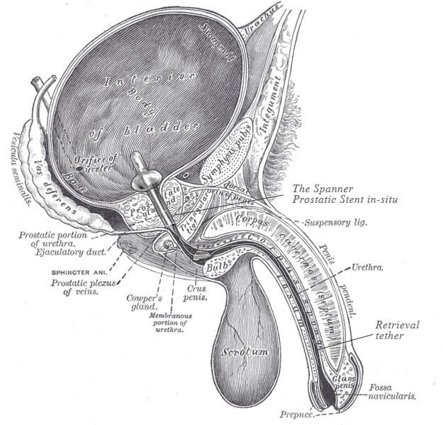 Prostatic stent