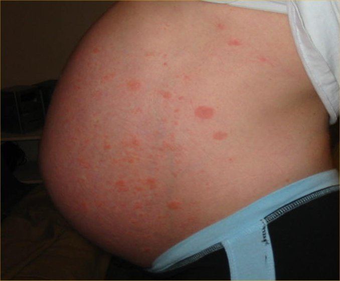 Pruritic urticarial papules and plaques of pregnancy